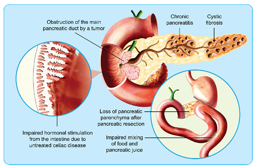  diagram, EPI og underliggende sygdomme
